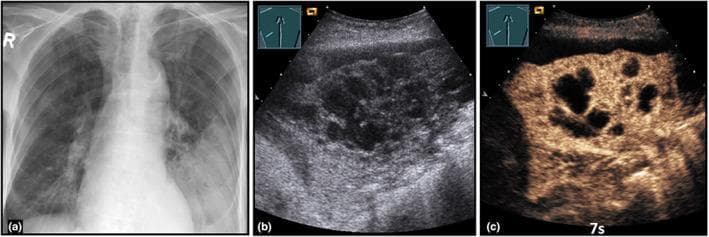 This composite figure illustrates a case of community-acquired abscessed pneumonia using three imaging modalities. Panel (a) is a posterior-anterior chest X-ray showing a low-field consolidation in the left lung. Panel (b) presents a B-mode Lung Ultrasound (LUS) of the same region, demonstrating a complex, hypoechoic consolidation. Within this consolidation, central anechoic areas are visible, representing confluent regions of necrosis or early abscess formation. Panel (c) displays a Contrast-Enhanced Ultrasound (CEUS) image at 7 seconds (pulmonary arterial phase). It reveals an inhomogeneous enhancement pattern throughout the consolidated lung tissue. Notably, there are multiple well-defined anechoic zones characterized by a total absence of enhancement, which confirms the presence of avascular abscess cavities. This multi-modal approach highlights the utility of CEUS in differentiating simple pneumonia from complicated, necrotizing, or abscessed pneumonia by visualizing microvascular perfusion and identifying non-perfused necrotic tissue.