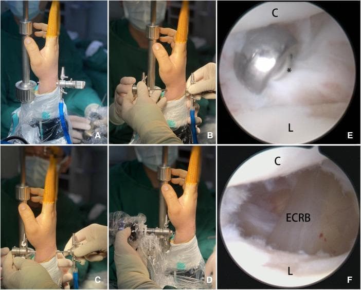 A multi-panel figure illustrating the 'Kiss-in' method for midcarpal arthroscopy (MCV) and subsequent ganglion cyst resection. Panels A through D are intraoperative clinical photographs showing a step-by-step surgical sequence. (A) Insertion of a blunt trocar into the radial midcarpal portal. (B) Meeting or 'kissing' of two trocar cannulas to form a continuous conduit. (C) Pushing the trocar assembly from the volar to the dorsal aspect through the joint. (D) Successful placement of the arthroscope through the established volar portal. Panels E and F provide intraarticular arthroscopic views during the procedure. (E) Visualization of the capitate (C) and lunate (L) bones with a surgical shaver (asterisk) excising the stalk of a ganglion cyst. (F) Continued debridement of the joint capsule distally toward the dorsal scapholunate ligament, exposing the underlying extensor carpi radialis brevis (ECRB) tendon. This visual material demonstrates an advanced technique for establishing portals and performing arthroscopic resection of wrist ganglia, highlighting key anatomical landmarks and instrument manipulation.