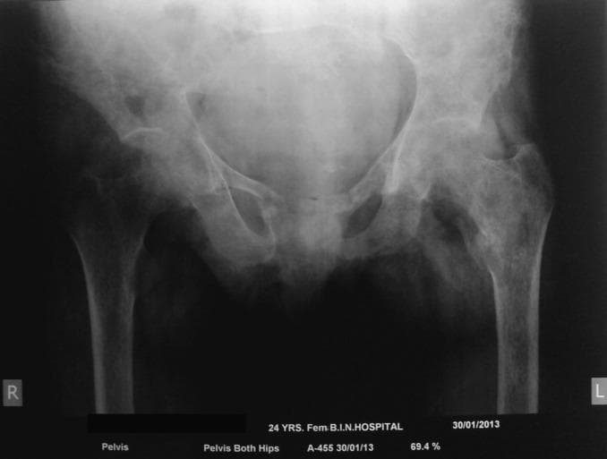 Anteroposterior (AP) X-ray of the pelvis and bilateral proximal femurs demonstrating classic radiographic signs of osteitis fibrosa cystica secondary to primary hyperparathyroidism. The image shows widespread, extensive lytic lesions (salt-and-pepper appearance) involving the iliac bones, superior and inferior pubic rami, and both femoral heads and greater trochanters. There is significant cortical thinning and generalized osteopenia, manifested as increased lucency across the skeletal structures. These subperiosteal and endosteal resorptive changes result in a mottled, heterogeneous bone texture and a loss of normal trabecular patterns. The findings represent brown tumors and bone remodeling typical of Von Recklinghausen's disease of bone, emphasizing the severe impact of chronically elevated parathyroid hormone (PTH) on skeletal integrity.