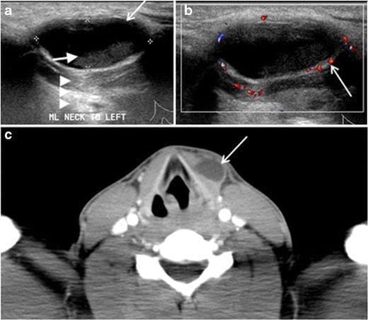 This composite figure displays diagnostic imaging of a long-standing infected thyroglossal duct cyst in a 29-year-old male. (a) Transverse greyscale ultrasound shows an oval, well-defined cystic lesion at the midline neck. It features low-level internal echoes (white arrows) and posterior acoustic enhancement (arrowheads), consistent with complex fluid. (b) Transverse color Doppler ultrasound demonstrates increased peripheral vascularity around the cyst wall (white arrow), indicating an inflammatory process. (c) Axial contrast-enhanced CT scan at the level of the thyroid cartilage reveals a well-circumscribed, homogeneous, hypoattenuating cystic lesion. The lesion is located slightly off-midline, embedded within the left strap muscle. It exhibits a prominent peripherally enhancing rim (white arrow) without internal calcifications or solid enhancing components. These findings are characteristic of an infected thyroglossal duct cyst, a common midline developmental remnant that may deviate from the midline when located caudally near the thyroid gland.
