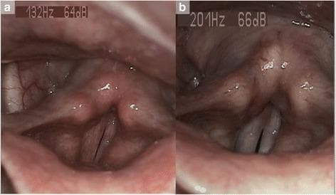 This diagnostic comparison contains two videostroboscopy frames illustrating the laryngeal manifestations of laryngopharyngeal reflux (LPR) before and after treatment. Panel (a) represents the baseline state, showing significant clinical signs including diffuse laryngeal erythema, inter-arytenoid redness, and posterior commissure hypertrophy. The vocal folds exhibit visible irritation and marginal irregularity, accompanied by pharyngolaryngeal edema. Panel (b) demonstrates the post-treatment state following a course of proton pump inhibitor therapy. Notable improvements include a marked reduction in mucosal inflammation and edema. The inter-arytenoid region appears less congested, and the vocal folds show restored smoothness and a healthier pearly-white coloration. This comparison is an educational resource for identifying Reflux Finding Score (RFS) criteria and monitoring therapeutic response in otolaryngology. The images demonstrate the reversal of tissue changes associated with chronic acid and pepsin exposure in the upper aerodigestive tract.