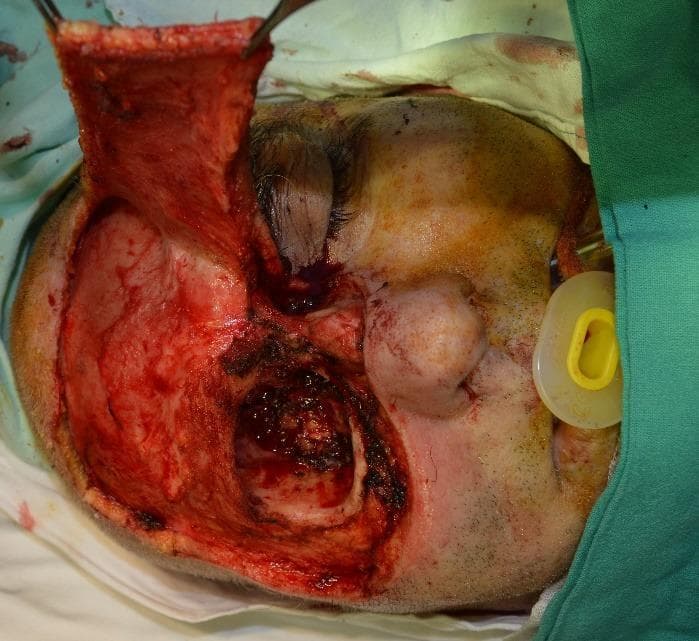 This clinical photograph captures a high-angle intraoperative view of a radical surgical excision and facial reconstruction. The patient is in a supine position, with the right side of the face showing intact skin, a closed eye, and an airway device (nasal cannula with a yellow cushion) in the right nostril. The left side of the face demonstrates a significant surgical defect following a subtotal maxillectomy and orbital exenteration. A large, vascularized frontal myofascial flap has been dissected and is being held superiorly by surgical instruments, ready for rotation to cover the primary defect. The surgical field reveals exposed deep soft tissues, bone margins of the orbital and maxillary regions, and evidence of cauterization and surgical trauma. This image serves as an educational resource for plastic and reconstructive surgery, illustrating the preparation of a regional flap for complex midface reconstruction following oncological resection.