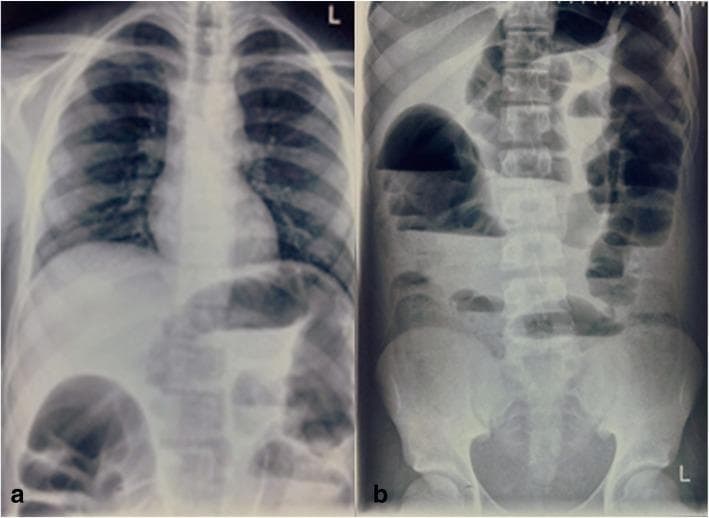 Two diagnostic X-ray images demonstrating clinical features of intestinal obstruction. Image (a) is a posteroanterior chest X-ray that shows clear lung fields and a normal cardiomediastinal silhouette, but notably reveals dilated bowel loops containing gas beneath the diaphragmatic plane. Image (b) is an anteroposterior erect abdominal X-ray, which is diagnostic for bowel obstruction. It displays multiple markedly dilated loops of bowel distributed throughout the central and peripheral abdominal cavity. Pathognomonic 'string of pearls' or 'stepladder' appearances are indicated by numerous air-fluid levels visible in the erect position. These findings are consistent with an acute mechanical intestinal obstruction or adynamic ileus, requiring further clinical correlation with the patient's history of rectal pathology and metastatic workup. The spinal column and pelvic structures appear unremarkable, focusing the clinical relevance on the abnormal bowel gas pattern.