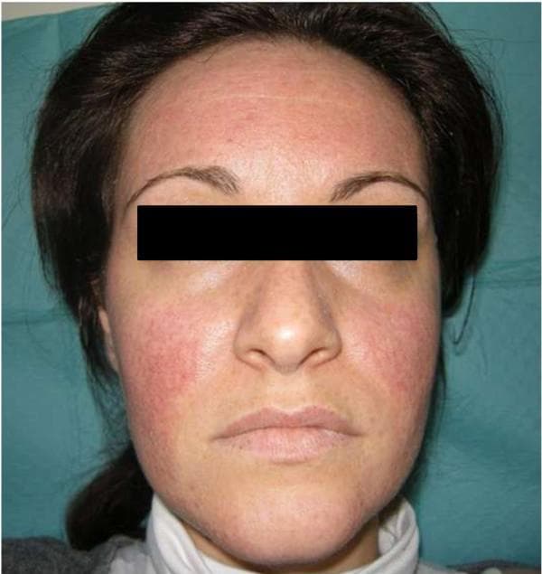 This clinical photograph displays a frontal view of a female patient's face, illustrating a drug-induced cutaneous eruption. The image demonstrates a diffuse, erythematous facial rash with a predominant distribution over the forehead and the malar (butterfly) regions. The erythema is characterized by a pink-to-red hue with an associated fine papular texture, most notably on the bilateral cheeks. Significant sparing is observed in the periorbital (orbicularis oculi) and lower perioral areas. The photograph captures the clinical state seven days following the cessation of a suspected causative agent (metformin), showing a partial resolution with decreased intensity of hyperemia and papular prominence compared to acute presentation. This visual is useful for teaching the morphological characteristics of drug-induced exanthems and their differentiation from dermatological conditions like rosacea or subacute cutaneous lupus erythematosus.
