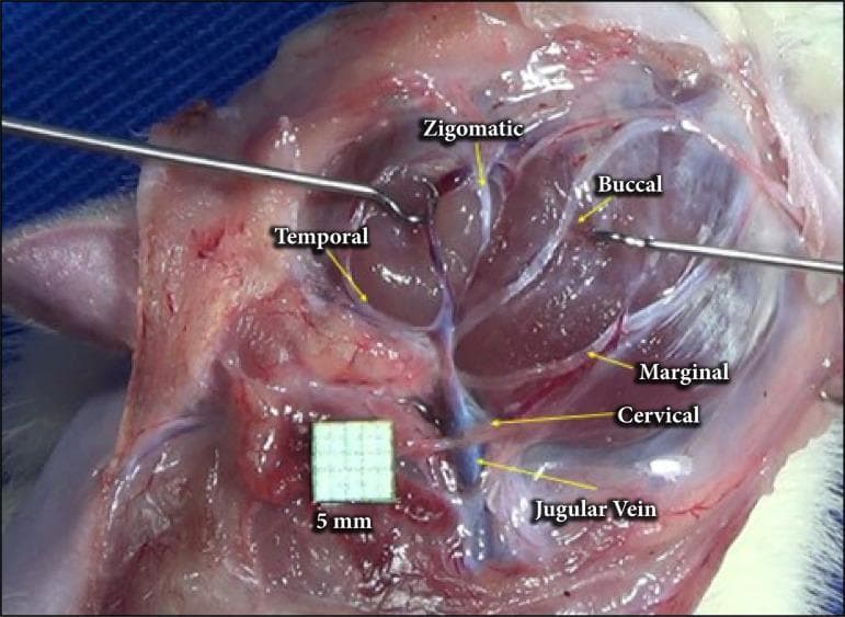 A clinical intraoperative photograph showing the anatomical arrangement of the facial nerve branches in a surgical dissection, following parotidectomy. The image provides a lateral view of the cervicofacial region where the parotid gland has been removed to expose the extratemporal facial nerve plexus. Labeled branches include the temporal branch extending superiorly, the zygomatic and buccal branches traveling toward the mid-face, and the marginal mandibular and cervical branches descending inferiorly. The cervical branch is depicted in close proximity to the jugular vein, which is visible in the lower surgical field. Surgical instruments (retractors) are positioned to maintain exposure of the deep tissues. A 5mm grid scale is included for anatomical measurement. This visual serves as an educational guide for surgical anatomy, identifying key landmarks for nerve preservation during parotid gland surgery or facial nerve decompression.