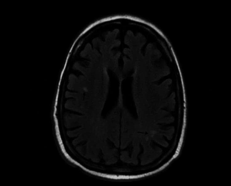 Diagnostic Image: This axial MRI slice of the brain, likely a Fluid-Attenuated Inversion Recovery (FLAIR) or T2-weighted sequence, demonstrates multifocal white matter changes. The primary pathology consists of small, punctate hyperintensities (indicated by black arrows) within the subcortical and deep white matter. Specifically, lesions are visible in the left frontal lobe region near the lateral ventricle's frontal horn and in the posterior left parietal/occipital region. The brain parenchyma shows preserved gray-white matter differentiation with normal sulcal and gyral patterns, and the ventricular system appears non-dilated and symmetric. In the clinical context provided, these non-specific white matter hyperintensities (WMH) are investigated for neuroinflammatory or infectious etiologies, such as neurosyphilis. The image serves as a clinical example of subcortical white matter disease and is suitable for educational modules on neuroradiology, neurology, and infectious disease manifestations in the central nervous system.