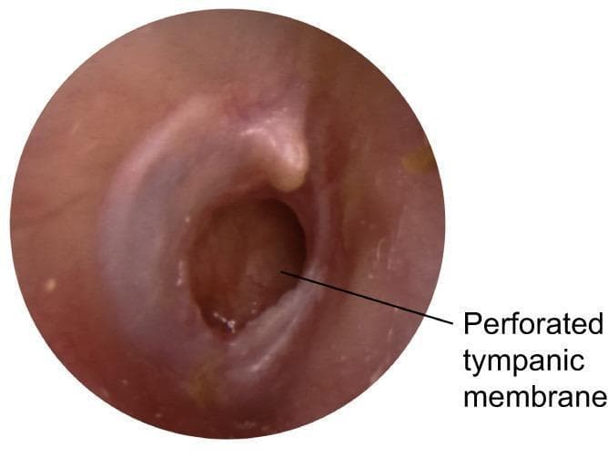This clinical photograph shows an otoscopic view of the right ear, demonstrating a large, subtotal perforation of the tympanic membrane located primarily in the posterior and inferior quadrants. The perforation is patent, revealing the underlying middle ear space, which appears dark and recessed. The remaining tympanic membrane tissue is erythematous and thickened, suggesting chronic inflammation, with a loss of the normal translucent, pearly-gray appearance and light reflex. The handle of the malleus is visible but obscured by the retracted and inflamed tissue. The external auditory canal appears relatively normal without signs of stenosis or active otorrhea at the time of imaging. This presentation is characteristic of chronic suppurative otitis media (CSOM), a condition defined by persistent tympanic membrane perforation and a history of intermittent or continuous discharge.