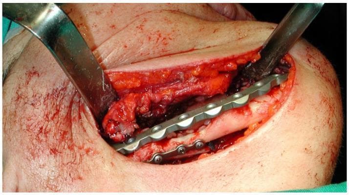 This clinical photograph captures an intra-operative view of a maxillofacial surgical procedure involving the reconstruction of the mandible. The surgical site is accessed through an external submandibular incision, with metallic retractors providing exposure of the mandibular bone. A silver-colored, multi-hole mandibular fixation plate is positioned along the mandibular corpus to provide stabilization and osteosynthesis. Four metallic screws are visible securing the inferior aspect of the plate to the bone. The surgical field shows signs of piezosurgery-based resection, with exposed bone segments aligned by the hardware. Surrounding soft tissues, including skin and subcutaneous fat, appear erythematous with expected minor surgical bleeding. The procedure is part of the management of Medication-Related Osteonecrosis of the Jaw (MRONJ), specifically addressing a stage III lesion that resulted in a mandibular fracture. This image serves as a clinical reference for mandibular reconstruction techniques and hardware placement in oral and maxillofacial surgery.