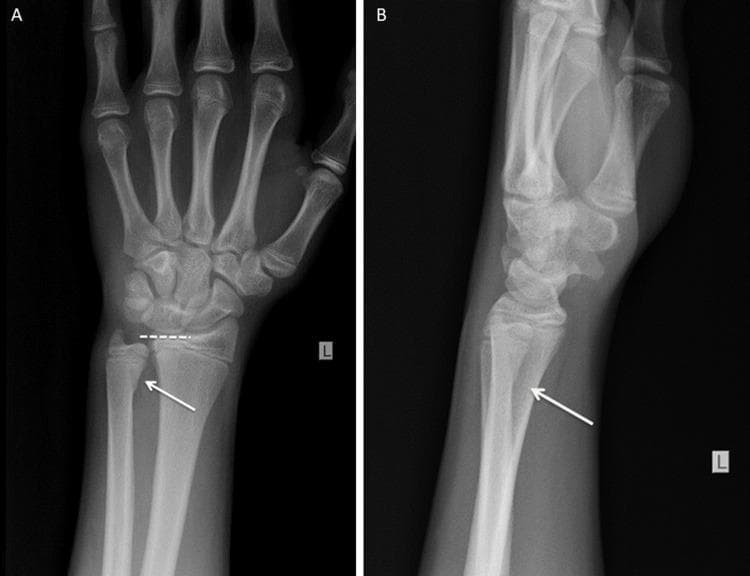 Diagnostic imaging of a pediatric left wrist featuring two X-ray views: Anteroposterior (A) and Lateral (B). The images demonstrate a Salter-Harris type II fracture of the distal ulnar epiphysis in a skeletally immature patient. View A shows a clear horizontal lucency through the ulnar growth plate with a small metaphyseal fragment (Thurston Holland sign), indicated by a white arrow. View B confirms the posterior displacement of the distal ulnar epiphysis relative to the shaft, also marked by an arrow. The adjacent distal radius appears intact without evidence of cortical disruption or physeal widening. The carpal bones, metacarpals, and visualized phalanges show normal alignment and ossification for the developmental age. This clinical image is illustrative of ulnar-sided physeal injuries typically resulting from a fall on an outstretched hand (FOOSH). Educational value lies in identifying Salter-Harris classification patterns and distinguishing physeal fractures from normal growth plate appearances in pediatric orthopedic trauma.