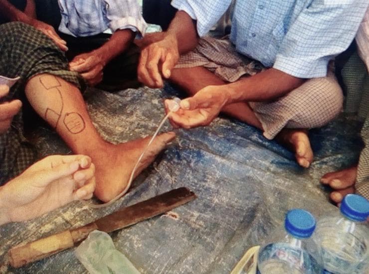 This clinical photograph illustrates a community-based demonstration of traditional healing practices for snakebite management. The central focus is a person's lower leg and foot, which feature black ink demarcations consisting of geometric outlines and a circular zone, likely indicating surgical or extraction boundaries. Parallel skin incisions are visible within these marked areas. An improvised suction device is depicted, consisting of a 20cc plastic syringe barrel (with the distal end removed) applied directly to the skin, connected via transparent tubing to a second syringe held by a practitioner to create negative pressure. On the ground adjacent to the limb is a large, weathered blade used for making the incisions. The scene highlights traditional first aid interventions, specifically the 'cut and suck' method, which is medically discouraged in modern toxicology due to the risks of secondary infection, tissue damage, and lack of efficacy in removing systemic venom. This image serves as educational material for global health and toxicology to illustrate cultural health practices and the challenges of pre-hospital snakebite care.