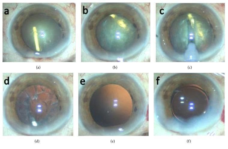 A series of six clinical intraoperative photographs (a–f) documenting a phacoemulsification cataract surgery complicated by an accidental intralenticular Ozurdex (dexamethasone) implant. (a) Displays a completed anterior continuous curvilinear capsulorrhexis (CCC). (b) Shows the intralenticular dexamethasone implant, visible as a rod-shaped semi-opaque structure, rotating within the opacified crystalline lens nucleus. (c) Illustrates the phacoemulsification probe creating a central groove in the lens nucleus to facilitate fragmentation. (d) Shows the eye after removal of the nucleus and implant, with remaining cortical remnants visible against the red reflex. (e) Demonstrates an intact and clear posterior capsule following complete irrigation and aspiration of cortical material. (f) Final stage showing the successful implantation of a three-piece hydrophobic acrylic intraocular lens (IOL) within the capsular bag. This series highlights the surgical management of lens trauma and iatrogenic implant displacement during cataract extraction.
