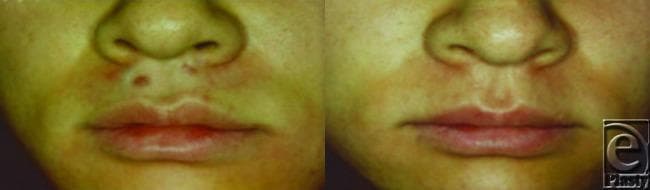 This comparison clinical photograph demonstrates a side-by-side progression of a post-burn hypertrophic scar on the philtrum and upper lip before and after Nd:YAG laser treatment. In the 'before' image (left), multiple raised, erythematous (red) nodules and plaque-like lesions are visible between the nasal base and the vermilion border. The scar tissue exhibits uneven texture, significant elevation, and distinct hyperpigmented and erythematous coloration compared to the surrounding skin. In the 'after' image (right), following five laser treatments, there is a marked clinical improvement. The previously elevated lesions show significant flattening (reduction in hypertrophy), and the associated erythema has notably diminished, leading to a more uniform skin tone. The overall texture of the perioral area appears smoother, with the scar tissue becoming less distinct and blending more naturally with the adjacent healthy tissue. This clinical case illustrates the efficacy of laser therapy in reducing the vascularity and volume of hypertrophic scarring in high-visibility facial regions.