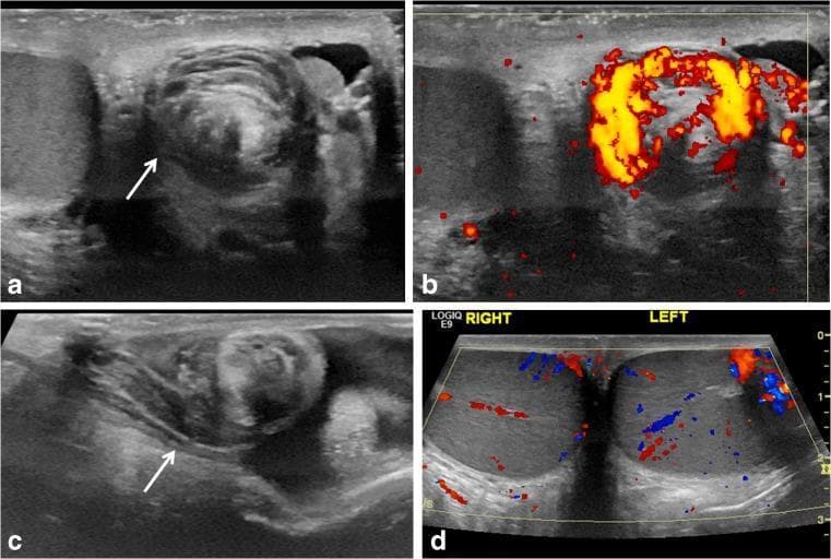 This composite of scrotal ultrasound images demonstrates the 'whirlpool sign,' a pathognomonic finding for testicular torsion. (a) Grayscale transverse ultrasound shows an eddy-like swirling of the spermatic cord (white arrow), indicating a spiral twist within the scrotal sac. (b) Power Doppler ultrasound of the same region reveals a concentric pattern of preserved blood flow within the vessels of the twisted cord, often seen in early or incomplete torsion. (c) Longitudinal grayscale ultrasound shows an abrupt spiral twisting of the spermatic cord at the level of the external inguinal ring (white arrow). (d) Transverse color Doppler ultrasound provides a bilateral comparison of the right and left testes; in this case of intermittent torsion, intratesticular vascular flow appears preserved and symmetrical bilaterally post-detorsion. These images illustrate key diagnostic markers for pediatric testicular torsion, emphasizing that the whirlpool sign is a direct sonographic indicator of cord rotation, even when intratesticular flow remains visible on Doppler interrogation.