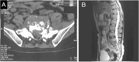 This composite diagnostic image illustrates lumbosacral spinal tuberculosis (Pott's disease) through axial CT and sagittal MRI views. Panel A is an axial CT scan showing extensive destruction of the S1 vertebral body, characterized by irregular bone margins, sequestrum (necrotic bone fragments), and a large, hypodense presacral cold abscess within the prevertebral space. Panel B is a sagittal T2-weighted MRI highlighting the involvement of the L5-S1 junction. Key findings include altered marrow signal intensity within the L5 and S1 vertebrae, significant narrowing of the L5-S1 intervertebral disc space, and the longitudinal extent of the presacral cold abscess. The visual findings demonstrate classic features of spinal infection, specifically the destruction of the anterior vertebral elements and the formation of characteristic cold abscesses typical of Mycobacterium tuberculosis infection in the lumbosacral region.