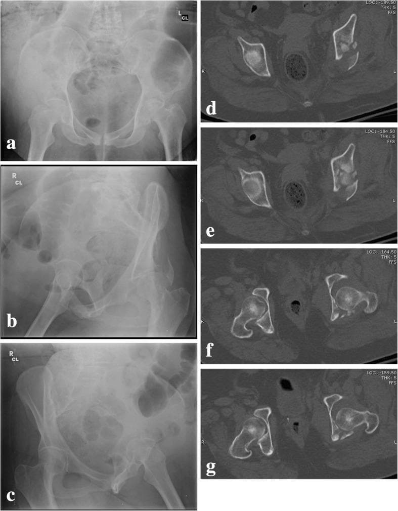 This composite figure presents pre-operative diagnostic imaging of a complex, comminuted transtectal transverse acetabular fracture with posterior wall involvement in a human patient. Panels (a–c) consist of conventional pelvic radiographs: (a) Anteroposterior view showing disruption of the ilioischial and iliopubic lines; (b) Obturator oblique view highlighting the anterior column and posterior wall; and (c) Iliac oblique view visualizing the posterior column and iliac wing. These images demonstrate significant disruption of the normal acetabular architecture and altered joint congruency. Panels (d–g) display axial Computed Tomography (CT) scans at different levels, providing a cross-sectional perspective of the fracture morphology. The CT slices clearly reveal the comminution of the acetabular roof, fracture lines extending through the quadrilateral surface, and displacement of the posterior wall fragments. The imaging collectively illustrates a T-shaped fracture pattern with high-energy articular impaction, serving as a teaching case for the Letournel classification and the assessment of femoral head stability (roof-arc measurements) in orthopedic trauma surgery.