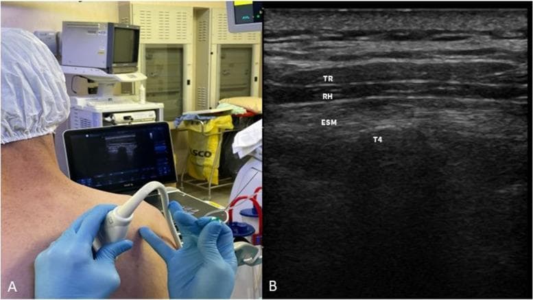 This composite educational image illustrates the clinical performance and sono-anatomy of an Erector Spinae Plane Block (ESPB). Panel A is a clinical photograph showing a patient in a seated position with a high-frequency linear ultrasound probe placed in a sagittal orientation on the upper back, approximately 3 cm lateral to the T4 spinous process. Panel B is a corresponding ultrasound image demonstrating the layered musculoskeletal anatomy of the thoracic region. The layers are identified from superficial to deep: the trapezius muscle (TR) is the most superficial, followed by the rhomboid major muscle (RH), and then the thicker erector spinae muscle (ESM). Deep to the ESM, the T4 transverse process (T4) appears as a distinct, hyperechoic linear structure with associated acoustic shadowing. This visualization is critical for identifying the target fascial plane for local anesthetic injection, located between the anterior fascia of the ESM and the transverse process. The image serves as a guide for regional anesthesia, particularly for cardiothoracic and thoracic surgical analgesia.