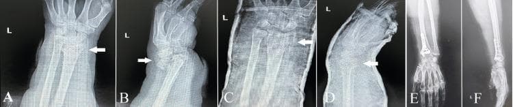 This composite of diagnostic radiographs illustrates the management sequence of a complex distal radius fracture in an elderly patient. Panels A and B (Anteroposterior and Lateral views) demonstrate a severely comminuted, intra-articular fracture of the distal radial epiphysis with significant dorsal displacement and multiple bone fragments. White arrows highlight the fracture lines and articular involvement. Panels C and D show the post-reduction state, where the wrist is immobilized in a radiopaque cast; alignment is improved, but the comminution remains visible. Panels E and F display the post-osteosynthesis outcome, showing definitive internal fixation with a volar locking plate and screws. The final images demonstrate anatomic reconstruction of the articular surface and restoration of radial length and inclination. This educational series highlights the transition from initial emergency presentation through closed reduction to surgical stabilization in orthopedic traumatology, specifically focusing on geriatric fracture management and the use of internal fixation hardware to achieve stability in poor-quality bone.