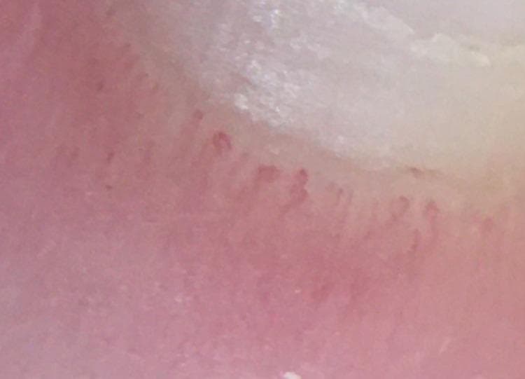 This clinical photograph displays a nailfold capillaroscopy of a patient, demonstrating classic microvascular changes associated with systemic sclerosis (SSc). The image reveals significant diagnostic abnormalities, most notably the presence of frequent 'giant capillaries' characterized by marked homogeneous dilation of the capillary loops. The overall capillary architecture shows a mild degree of disorganization compared to the typical linear 'hairpin' arrangement seen in healthy subjects. Furthermore, there is a moderate reduction in capillary density, with visible areas of capillary loss or 'dropout,' which are hallmarks of progressive microangiopathy in scleroderma-spectrum disorders. These findings serve as critical bedside diagnostic indicators for connective tissue diseases and correlate with systemic manifestations such as Raynaud's phenomenon and internal organ involvement.