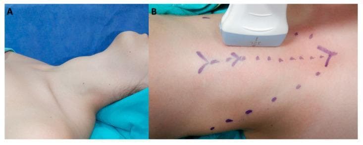 This composite of clinical photographs illustrates the preoperative preparation and intraoperative evaluation for thyroid surgery. Panel A shows a patient in the supine position under general anesthesia, with the neck extended to provide optimal exposure of the anterior cervical region. The visible anatomy includes the lower mandible, the submental and anterior neck areas, and the superior thoracic inlet. Panel B demonstrates the application of an 8–12 MHz linear ultrasound transducer on the skin surface for the ultrasonographic evaluation of the thyroid gland. Purple surgical ink markings on the neck denote the midline and key anatomical landmarks or intended incision pathways, including a dotted line and directional arrows. This sequence highlights the importance of patient positioning and the use of intraoperative ultrasonography for precise volumetric measurement and surgical planning in endocrine surgery, such as total thyroidectomy.