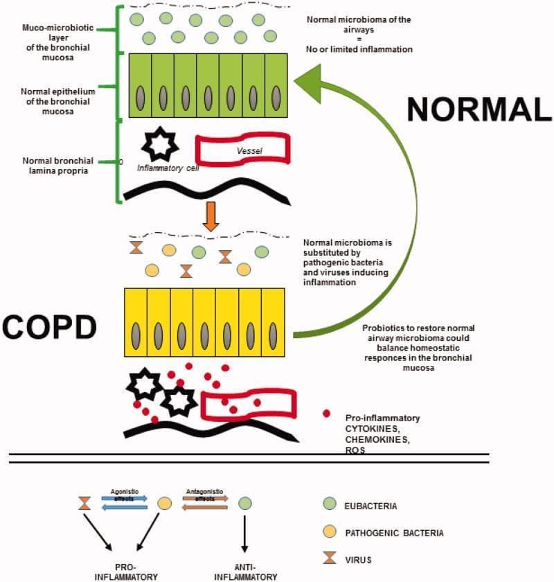 This medical schematic contrasts the airway mucosa and muco-microbiotic layer between healthy (Normal) subjects and Chronic Obstructive Pulmonary Disease (COPD) patients. The diagram is divided into two primary sections. The top 'Normal' section shows a healthy bronchial mucosa consisting of a muco-microbiotic layer populated by eubacteria (green circles), an orderly green columnar epithelium, and a lamina propria with minimal inflammatory presence. The middle 'COPD' section illustrates dysbiosis, where the eubacteria are replaced by pathogenic bacteria (yellow circles) and viruses (hourglass symbols). This microbial shift is associated with an inflammatory state in the bronchial-bronchiolar mucosa, characterized by increased inflammatory cells (black star shapes), pro-inflammatory cytokines, chemokines, and reactive oxygen species (ROS) (red dots), and vascular involvement in the lamina propria. A bottom legend describes the signaling logic: eubacteria exert anti-inflammatory effects and act as antagonists to pathogenic bacteria, while pathogenic bacteria and viruses exert agonist-challenging pro-inflammatory effects. The diagram highlights the potential role of probiotics in restoring lung homeostasis.