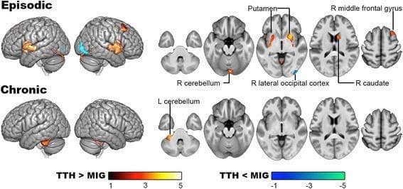 This diagnostic image displays voxel-based morphometry (VBM) results from a post-hoc 2x2 ANCOVA analysis comparing gray matter (GM) volume in patients with tension-type headache (TTH) and migraine (MIG). The visualization includes lateral cortical surface maps and sequential axial slices of the brain, divided into 'Episodic' and 'Chronic' rows. In the Episodic comparison, TTH shows significantly higher GM volume (indicated by red-yellow heat maps) in the bilateral putamen, right caudate, right middle frontal gyrus, and right cerebellum, while lower GM volume (indicated by blue-cyan) is visible in the right lateral occipital cortex compared to episodic migraine. In the Chronic comparison, significantly higher GM volume in TTH is localized only to the left cerebellum, with no significant regions of lower GM volume relative to chronic migraine. These findings illustrate neuroanatomical differences in pain processing and inhibitory regions between primary headache types, highlighting a reduction in structural divergence as the conditions transition from episodic to chronic forms.