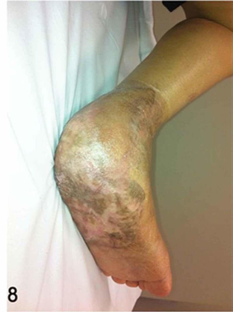 This clinical photograph displays a lateral and plantar view of a human foot at a 12-week follow-up, demonstrating the successful integration of a free musculocutaneous flap and a split-thickness skin graft. The surgical site covers the posterior heel and extends onto the plantar aspect, which was previously a site of deep necrosis and bone exposure. The grafted area shows characteristic variegated pigmentation with a mixture of dark brown, tan, and pale pinkish-white tones, indicative of post-operative remodeling and melanocyte activity. The texture of the graft is relatively smooth and stable, though it exhibits slight surface irregularities and a visible, well-defined border where it meets the native skin of the distal leg and ankle. There are no signs of active inflammation, erythema, dehiscence, or infection. This image illustrates late-stage surgical healing and soft-tissue reconstruction in the management of complex diabetic foot ulcers.