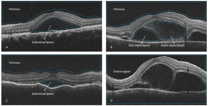Diagnostic optical coherence tomography (OCT) B-scans of the retina comparing fluid accumulation patterns in Central Serous Chorioretinopathy (CSCR) and Vogt-Koyanagi-Harada (VKH) disease. Panel A (CSCR) and Panel C (VKH without septa) show classic subretinal fluid (SRF) manifesting as hyporeflective spaces between the neurosensory retina and the retinal pigment epithelium (RPE), characterized by a single, continuous fluid pocket. Panel B illustrates VKH with subretinal septa, featuring thin, hyperreflective membranes (septa) that compartmentalize the subretinal space into 'supra-septa' and 'sub-septa' fluid pockets. Panel D demonstrates the segmentation of the 'entire region' for optical intensity analysis. The images highlight key morphological biomarkers in inflammatory uveitis (VKH), specifically the presence of subretinal fibrin or septa, which distinguishes it from the typically non-septated fluid seen in CSCR. The educational focus is on identifying subretinal compartmentalization and assessing the reflectivity (optical intensity) of fluid in different posterior segment pathologies.