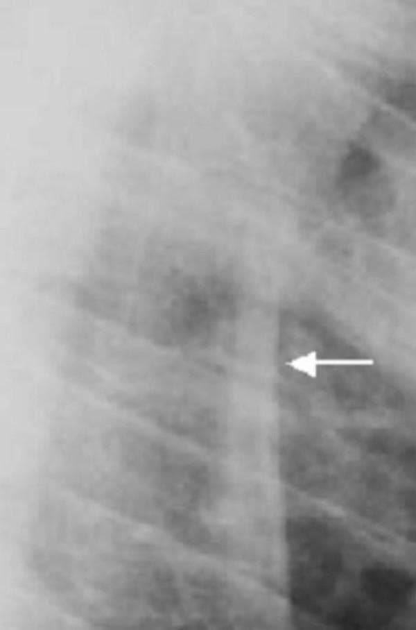 This lateral X-ray radiograph of the thoracic spine demonstrates advanced bone pathology characteristic of a systemic sclerosing bone disorder. The primary diagnostic finding is marked sclerosis of the vertebral rim circumference and the anterior longitudinal ligaments. A white arrow highlights a region where progressive ossification of these ligaments has resulted in bony ankylosis, appearing as radiopaque bridging and fusion between adjacent vertebral bodies. The vertebral bodies themselves exhibit increased bone density but lack signs of platyspondyly (vertebral flattening). These visual findings indicate a significant reduction in spinal mobility and flexibility due to the loss of distinct intervertebral spaces. The image serves as a clinical example of how progressive sclerosis in skeletal dysplasias or inflammatory spondyloarthropathies leads to structural fusion and altered biomechanical integrity of the spinal column.