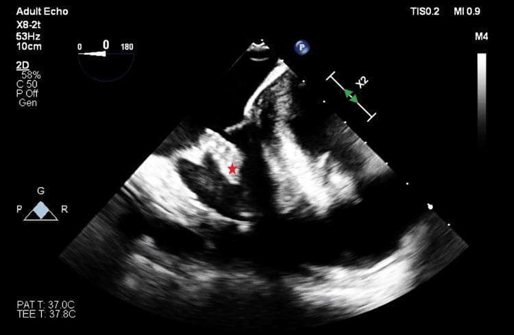 This diagnostic image is a transesophageal echocardiography (TEE) still, specifically a mid-esophageal four-chamber view of an adult heart. The primary finding is a discrete, echogenic mass (marked with a red asterisk) associated with the tricuspid valve, appearing to adhere to the posterior leaflet. The mass demonstrates a distinct texture and density compared to the surrounding cardiac chambers and septal walls. On-screen annotations include technical parameters such as a probe frequency of 53Hz, a 10cm imaging depth, and patient/probe temperatures (37.0°C and 37.8°C respectively). Mechanical and thermal indices (MI 0.9, TIS 0.2) are visible, along with a 0-degree sector sweep angle and a probe orientation diagram. This image is clinically significant for evaluating right-sided valvular pathology, specifically potential vegetations, thrombi, or primary cardiac tumors like fibroelastomas, within the context of intraoperative monitoring.