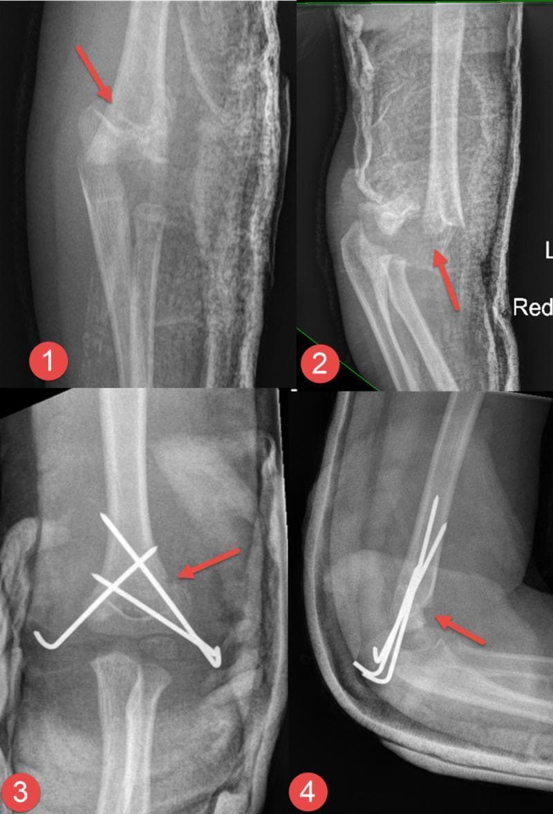 Diagnostic radiographic series of a pediatric elbow demonstrating a supracondylar humerus fracture and its subsequent surgical management. The series is divided into four panels: (1) Pre-operative anteroposterior (AP) view showing a displaced fracture of the distal humerus; (2) Pre-operative lateral view highlighting significant posterior displacement and angulation of the distal fragment; (3) Post-operative AP view showing successful closed reduction and internal fixation; (4) Post-operative lateral view confirming anatomic alignment. The fracture is stabilized using three percutaneous Kirschner wires (K-wires). Two wires are inserted from the lateral epicondyle in a divergent configuration, while a third wire is inserted from the medial epicondyle, crossing the fracture site to provide rigid stability. Red arrows in each panel point to the primary fracture line and the site of surgical reduction. The images illustrate standard orthopedic management of pediatric supracondylar fractures to prevent malunion and neurovascular complications.