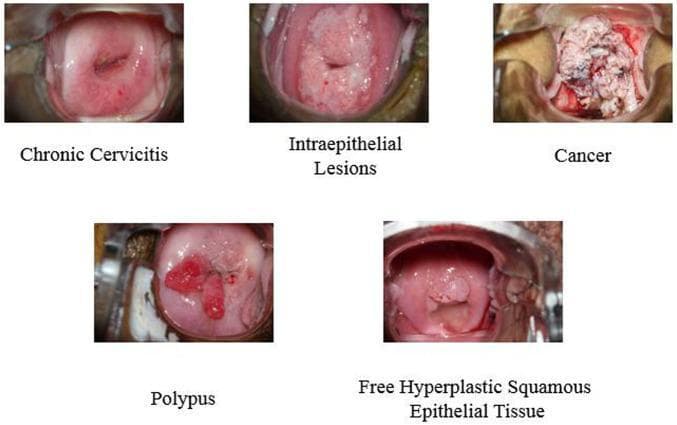 This composite of clinical colposcopy photographs illustrates five distinct pathological states of the human cervix. 1. Chronic Cervicitis: Shows a relatively smooth, erythematous ectocervix with a linear lesion and punctate hemorrhages around the external os. 2. Intraepithelial Lesions: Features a thickened, opaque, whitish acetowhite-like area covering the transformation zone, suggesting dysplastic changes. 3. Cervical Cancer: Displays an advanced neoplastic state characterized by a large, exophytic, friable mass with an irregular, cauliflower-like texture and variegated color (whitish and necrotic red areas) obscuring normal anatomy. 4. Polypus (Cervical Polyp): Exhibits a distinct, pedunculated, smooth, fleshy red growth protruding from the cervical canal. 5. Free Hyperplastic Squamous Epithelial Tissue: Shows a more subtle, uniform, pinkish elevation of the squamous epithelium without the severe disruption seen in malignancy. These images serve as educational references for gynecological oncology and colposcopic diagnosis, highlighting key morphological differences in texture, color, and tissue architecture used to distinguish benign inflammation from precancerous lesions and invasive carcinoma.