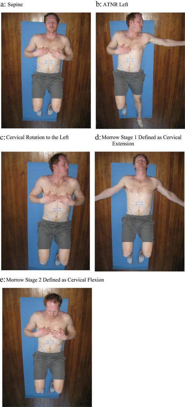 A series of clinical photographs (a-e) showing a male subject in various supine positions used to evaluate abdominal muscle activation in response to primitive reflex stimulation. Six surface electromyography (EMG) electrodes are bilaterally arranged on the abdomen: two over the rectus abdominis (inferior to the xiphoid), two superior to the anterior superior iliac spines (ASIS) for the external obliques, and two medial to the ASIS for the internal obliques.
Positions include:
(a) Neutral supine.
(b) Asymmetric Tonic Neck Reflex (ATNR) Left: Head rotated left, left arm/leg extended, right arm/leg flexed.
(c) Cervical Rotation Left: Head rotated left with symmetric limb flexion.
(d) Moro Stage 1: Cervical extension with bilateral arm abduction.
(e) Moro Stage 2: Cervical flexion with arms resting on the chest.
The series demonstrates a kinesiopathology protocol aimed at identifying clinical differences in muscle recruitment patterns, often used in chronic low back pain (CLBP) research to investigate retained primitive reflexes.