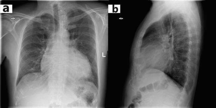 This diagnostic image displays a standard chest X-ray in two views: (a) Posteroanterior (PA) frontal view and (b) Lateral profile view. The frontal view reveals significant enlargement of the cardiac silhouette, known as cardiomegaly, with an increased cardiothoracic ratio (CTR). The heart exhibits a widened, somewhat globular shape, which is a classic radiographic sign associated with a large pericardial effusion ('water bottle heart' configuration). In the lateral view (b), the enlarged cardiac shadow occupies an increased portion of the retrosternal space, further confirming global cardiac enlargement. Despite the cardiomegaly, the lung fields appear relatively clear without overt signs of pulmonary edema or cephalization of vessels. The costophrenic angles are visible, and the diaphragm maintains a normal contour. This clinical photograph is a primary teaching example for identifying cardiomegaly and assessing the cardiothoracic ratio in the context of acute pericarditis or pericardial effusion.