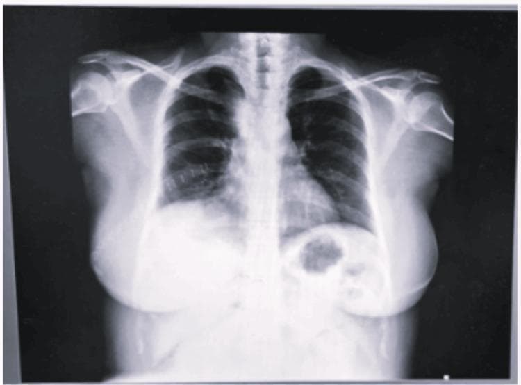 This diagnostic image is a posteroanterior (PA) view chest X-ray. The primary finding is a large, well-circumscribed, rounded, and homogenous opacity located in the right upper hemithorax. The opacity demonstrates significant mass effect, resulting in a notable lateral deviation of the trachea toward the left side, particularly above the level of the carina. The medial border of the mass abuts the mediastinum, causing widening and partially obscuring the superior right heart border. The right hemi-diaphragm is difficult to distinguish due to the density of the mass. In contrast, the left lung field appears clear with normal bronchovascular markings, and the left costophrenic angle is sharp. The cardiac silhouette, where visible, is within normal limits for size. This radiograph illustrates key educational concepts regarding mediastinal masses, such as bronchogenic cysts, and their secondary effects on airway patency and anatomical displacement. It is appropriate for medical students and radiology residents studying thoracic pathology and the interpretation of obstructive mass lesions.