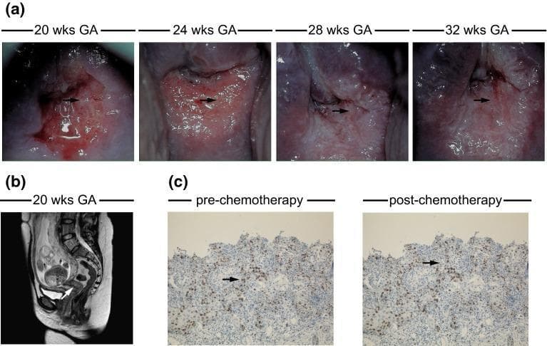 This composite educational image illustrates the longitudinal management of FIGO stage IB1 cervical cancer during pregnancy. (a) A series of colposcopy images at 20, 24, 28, and 32 weeks gestational age (GA) demonstrates the cervical tumor's evolution during neoadjuvant chemotherapy. Initial images show atypical vessels and ulceration (indicated by arrows), with subsequent images following the clinical response. (b) A sagittal T2-weighted MRI at 20 weeks GA shows a gravid uterus and the cervical tumor, characterized by increased size and high signal intensity (arrow), used for staging and excluding lymph node involvement. (c) Immunohistochemistry (IHC) micrographs (100x magnification) compare squamous cell carcinoma (SCC) tissue pre- and post-chemotherapy. Brown staining (arrows) indicates Ki-67 expression, a marker of cellular proliferation, while hematoxylin (blue) provides nuclear counterstaining. These panels demonstrate the integration of clinical colposcopy, diagnostic imaging, and histopathology in monitoring gestational malignancy and treatment response.