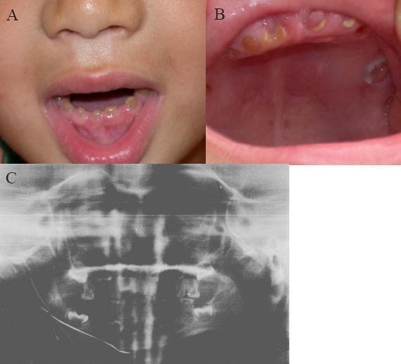 This composite medical image displays clinical and radiographic findings characteristic of Dentinogenesis Imperfecta (DGI) Type II in a pediatric patient. Panels A and B are clinical photographs of the oral cavity showing the primary dentition. The teeth exhibit a distinct amber to brownish discoloration and a translucent appearance. There is evidence of severe attrition, with the enamel layer appearing significantly thinned or absent, leading to the rapid wear of the underlying dentin and a flattened crown morphology. Panel C is a panoramic radiograph (Panorex) of the same individual, providing a comprehensive view of the maxillary and mandibular dental arches. The radiograph reveals typical features of DGI, which often include bulbous crowns, cervical constriction (neck-like appearance at the cementoenamel junction), and partial or complete obliteration of the pulp chambers and root canals due to excessive dentin deposition. The image serves as a clinical reference for hereditary dentin defects associated with DSPP gene mutations, highlighting the diagnostic transition from visual clinical signs to radiographic confirmation of structural anomalies.