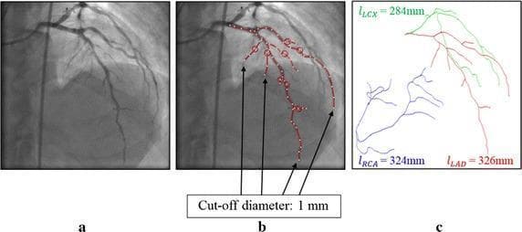 This figure illustrates the process of measuring coronary artery lengths for OCT-FFR simulation using coronary X-ray angiography (CAG). Panel (a) presents a raw clinical diagnostic image of the left coronary arterial tree. Panel (b) shows the same angiogram with an overlay of red circles and connecting lines, indicating the vessel segments selected for length calculation based on a minimum cut-off diameter of 1 mm. Panel (c) provides a segmented anatomical diagram and quantitative data representing the total lengths of the primary coronary arteries. In this panel, the Left Anterior Descending artery (LAD) is color-coded red with a measured length of 326 mm, the Left Circumflex artery (LCX) is green at 284 mm, and the Right Coronary Artery (RCA) is blue at 324 mm. This visualization demonstrates the methodology for estimating regional coronary resistance based on vascular anatomy to support hemodynamic modeling and fractional flow reserve (FFR) calculations in cardiology.