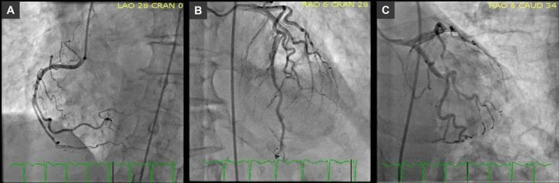 A composite diagnostic image featuring three panels (A, B, C) of invasive coronary angiography demonstrating a normal coronary anatomy with right dominance. Panel A shows a Left Anterior Oblique (LAO) view of a dominant Right Coronary Artery (RCA). The vessel originates from the right aortic sinus and follows the atrioventricular groove, providing robust perfusion to the inferior wall of the myocardium via the posterior descending artery (PDA). Panel B presents a Right Anterior Oblique (RAO) cranial view of the Left Anterior Descending (LAD) artery. The LAD is seen traversing the anterior interventricular groove with patent diagonal branches and septal perforators, showing no flow-limiting stenoses or atherosclerotic lesions. Panel C displays the Left Circumflex (LCx) artery and its obtuse marginal branches in an RAO caudal projection, also exhibiting smooth vessel caliber and patent flow. The images collectively serve as a reference for normal coronary distribution and the absence of obstructive coronary artery disease in a clinical workup for cardiac dysfunction, such as stress-induced cardiomyopathy.