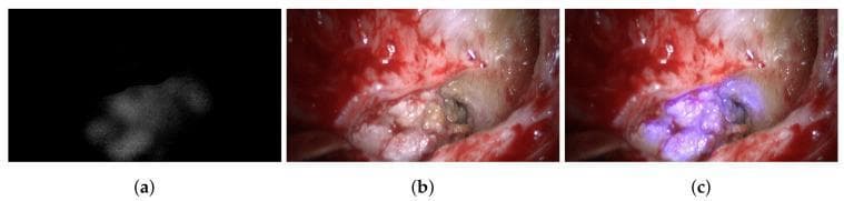 This surgical endoscopic comparison chart demonstrates the use of multispectral imaging in identifying middle ear pathology. The image is divided into three panels: (a) a spectrally segmented view under 420 nm illumination, appearing as a grayscale intensity map that highlights the spatial distribution of a cholesteatoma against a dark background; (b) a standard RGB broad-band illumination view showing the intraoperative surgical field, characterized by reddish soft tissue, white osseous structures, and the presence of pale, keratinous debris; and (c) an augmented spectral RGB view. In this final panel, the data from the spectral segmentation is overlaid onto the clinical photograph, highlighting the cholesteatoma tissue with a distinct bluish-purple hue. This comparison illustrates how multispectral imaging can differentiate between benign bone and pathological cholesteatoma during otological surgery. The anatomical context involves the mastoid cavity and middle ear, focusing on the identification and removal of recurrent cholesteatoma to assist surgical guidance and ensure complete resection.