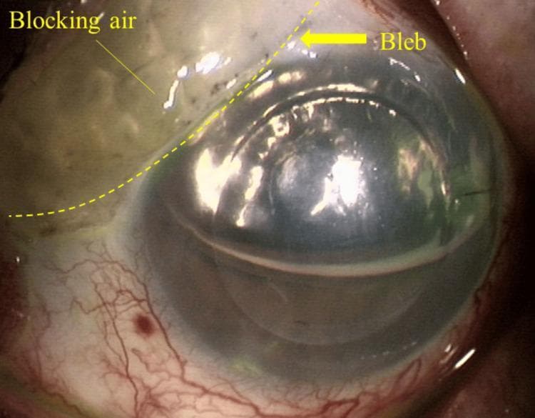 This slit-lamp clinical photograph demonstrates an ophthalmological complication following Descemet's stripping automated endothelial keratoplasty (DSAEK). The image focuses on a superior filtering bleb, previously created during a glaucoma-filtering surgery (trabeculectomy). Visible within the bleb is a phenomenon termed 'blocking air,' where air from the anterior chamber has migrated into the subconjunctival space. The bleb appears elevated and cystic, located at the superior limbal area. A dashed yellow line outlines the extent of the air bubble, which presents as a translucent, irregular area within the superior-left portion of the bleb. The cornea is central and appears slightly hazy, characteristic of early postoperative DSAEK. The underlying anterior chamber shows a visible fluid-air interface. The inferior conjunctiva and sclera exhibit moderate injection with prominent vascularization. This image illustrates the interaction between corneal transplant surgery and pre-existing glaucoma drainage structures, specifically highlighting how therapeutic air used to tamponade a corneal graft can unintentionally enter a functional filtering bleb, potentially impacting intraocular pressure and graft stability.