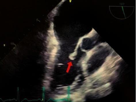 This diagnostic image is a transesophageal echocardiogram (TEE) demonstrating infective endocarditis of the mitral valve. The ultrasound shows a clear, irregular hyperechoic mass, indicated by a red arrow, which represents a vegetation attached to the valve apparatus. Specifically, the vegetation is localized to the lateral posterior (P2) segment of the mitral valve leaflet. Adjacent cardiac structures, including the mitral valve leaflets and chordae tendineae, are visible within the left heart chambers. The image illustrates the classic sonographic presentation of vegetations, which are hallmark findings in bacterial endocarditis (clinically associated here with Staphylococcus hominis). The scan provides critical diagnostic evidence for assessing valve morphology and the risk of embolic events. Educational focus includes the identification of valvular vegetations and understanding their typical location on the atrial side of atrioventricular valves in the context of systemic infection.
