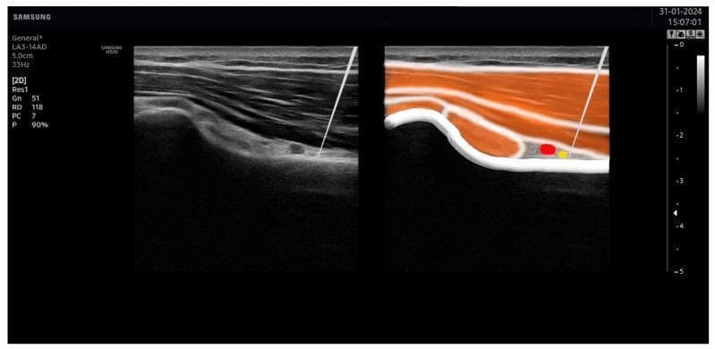 This dual-panel image displays an ultrasound-guided needle placement in the posterior shoulder region, specifically targeting the axillary nerve. The left panel shows a grayscale 2D ultrasound in a longitudinal view of the deltoid muscle and transverse view of the quadrangular space. A hyperechoic, straight line representing the needle is visible using an 'in-plane' technique, penetrating through the moderately echogenic, striated muscle layers. The right panel provides a corresponding color-coded anatomical illustration overlaid on the ultrasound scan to identify key structures: the deltoid and teres minor muscles (orange), the humerus cortical bone (white hyperechoic curve), the axillary artery (red), and the axillary nerve (yellow). The needle tip is precisely positioned adjacent to the yellow-coded axillary nerve, demonstrating the correct clinical procedure for percutaneous electrical nerve stimulation (PENS) or regional anesthesia while avoiding vascular puncture. This educational visual aids in understanding musculoskeletal ultrasound anatomy and needle-to-nerve proximity.