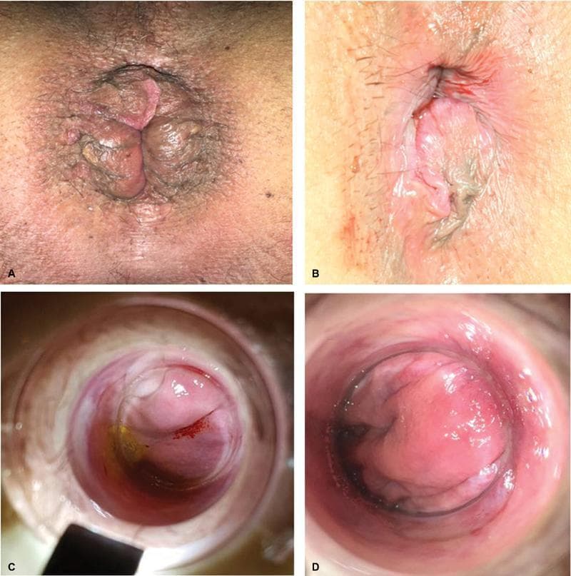 This composite of clinical photographs illustrates varying degrees and presentations of hemorrhoidal disease and rectal prolapse. Panels A and B are external clinical photographs of the perianal region. Panel A demonstrates a moderate external prolapse with visible circumferential mucosal folds, tissue congestion, and associated hyperpigmentation of the surrounding perianal skin. Panel B shows a smaller, less pronounced prolapse with smoother, pinker mucosal tissue and less significant skin changes. Panels C and D provide an endoscopic or anoscope view of internal structures. Panel C highlights an internal asymmetrical prolapse characterized by prominent vascular patterns, focal erythema (red streaking), and areas of yellowish serous or mucosal discoloration. Panel D displays a well-detectable hemorrhoidal peduncle viewed through a surgical or diagnostic instrument, showing more uniform pink mucosal tissue and a distinct anatomical protrusion. These images serve as an educational comparison of hemorrhoidal classification, ranging from minor external prolapse to identifiable internal vascular pedicles, relevant for proctological diagnosis and treatment planning.