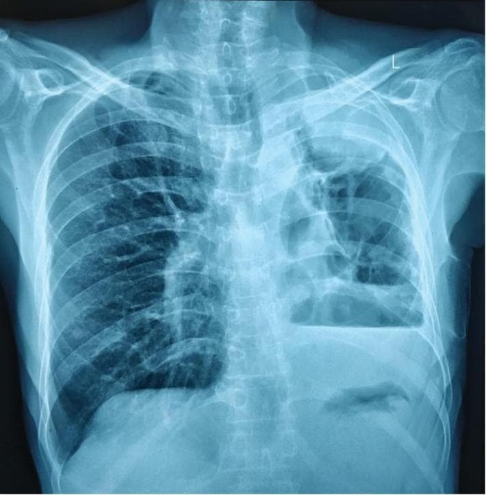 This diagnostic image is a posteroanterior (PA) chest X-ray demonstrating a severely diseased and contracted left lung, indicative of a 'destroyed lung' phenotype. The left hemithorax shows significant volume loss, characterized by an ipsilateral mediastinal shift (tracheal and cardiac deviation to the left) and narrowing of the intercostal spaces. Multiple large, thin-walled cavitary lesions are visible in the upper and middle zones of the left lung, with a prominent air-fluid level suggestive of a large abscess or infected cavity. A dense opacity is noted in the left apex. The left costophrenic angle is obliterated by a hazy density consistent with a moderate pleural effusion or pleural thickening. In contrast, the right lung field appears hyperinflated, likely due to compensatory hypertrophy. This radiographic presentation is clinically relevant for chronic pulmonary infections such as necrotizing pneumonia (e.g., Klebsiella) or sequelae of pulmonary tuberculosis, illustrating the long-term anatomical distortions caused by extensive parenchymal destruction.