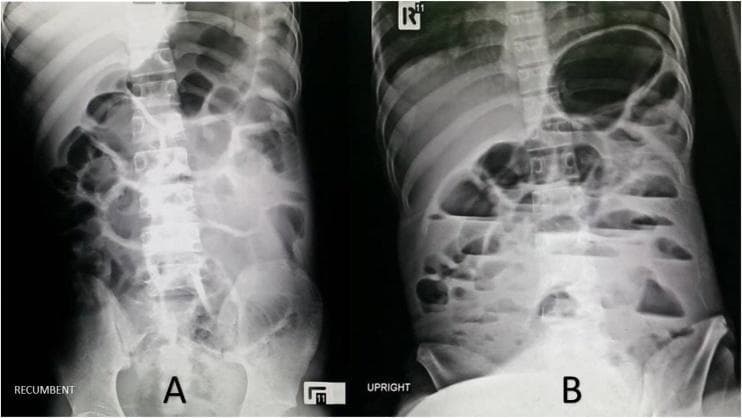 Diagnostic Image: This abdominal radiograph (X-ray) panel displays a comparison between recumbent (A) and upright (B) views of a 19-year-old patient. The images demonstrate significant pathological dilatation of both small and large bowel loops, characteristic of generalized ileus. In the recumbent view (A), gas-filled intestinal segments are dispersed across the abdominal cavity, revealing prominent valvulae conniventes and haustral markings indicative of gaseous distension. In the upright view (B), multiple air-fluid levels are clearly visible within the dilated loops, manifesting as horizontal lines where gas interfaces with fluid due to gravity. These findings suggest a functional bowel obstruction or paralytic ileus. The imaging is critical for differentiating between mechanical obstruction and generalized dysmotility. Educational concepts illustrated include the radiographic signs of bowel distension, the diagnostic utility of positional X-rays in emergency medicine, and the identification of air-fluid levels as markers of impaired intestinal transit.