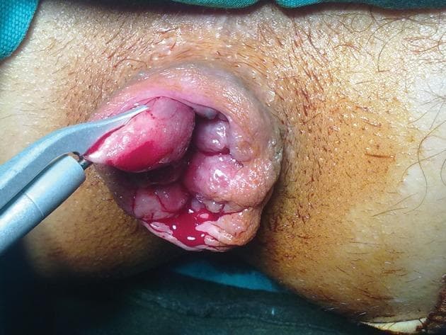 This clinical photograph captures an intraoperative view of a surgical procedure for grade IV internal hemorrhoids. The patient is in the lithotomy position, revealing significant protrusion of prolapsed hemorrhoidal tissue from the anal canal. The tissue is characterized by multiple erythematous, edematous, and lobulated masses with visible vascular congestion and minor active bleeding. A harmonic scalpel (ultrasonic energy device) is shown in use, with its metallic, curved blades grasping and coagulating a portion of the hemorrhoidal pile for excision. This visual demonstrates the Milligan-Morgan open hemorrhoidectomy technique, highlighting the use of advanced energy devices to achieve simultaneous dissection and hemostasis. The surrounding perianal skin and surgical draping are visible, providing clinical context for proctological surgery within a general or colorectal surgery specialty. The educational focus is on surgical management of severe hemorrhoidal disease and the application of energy-based surgical instruments in anorectum procedures.