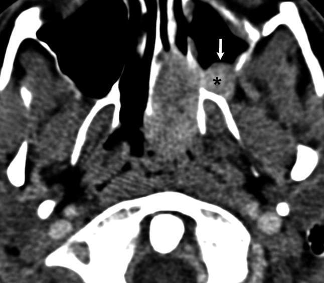 This diagnostic image is an axial contrast-enhanced CT scan of the maxillofacial region and skull base. The scan demonstrates characteristic features of a juvenile nasopharyngeal angiofibroma (JNA) with significant local extension. A prominent soft tissue mass of intermediate density is visible, originating in the nasopharynx and extending laterally. A key diagnostic feature shown is the 'Holman-Miller sign,' characterized by the anterior (forward) displacement and bowing of the posterior wall of the maxillary sinus, indicated by a white arrow. The tumor has also invaded the pterygopalatine fossa, marked by an asterisk, appearing as an area of abnormal soft tissue density with contrast enhancement. This lateral spread pattern often precedes further extension into the infratemporal fossa. The imaging modality highlights the relationship between the hypervascular tumor and surrounding bony structures, illustrating bone remodeling and displacement rather than aggressive destruction. This material is suitable for teaching radiological signs of benign but locally invasive sinonasal tumors.