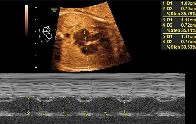 Diagnostic ultrasound image featuring a fetal echocardiogram in a 26-week gestational age fetus, used for assessing cardiac function in the context of gestational diabetes mellitus (GDM). The visual is divided into two primary sections: a top panel showing a B-mode (2D) cross-sectional view of the fetal heart and a bottom panel showing an M-mode tracing. In the B-mode image, a yellow vertical sampling line passes through the cardiac chambers to obtain the M-mode data. The M-mode tracing displays cyclical motion of the atrial walls over several cardiac cycles. Yellow callipers (marked 1-6) measure the maximum and minimum dimensions of the chamber, facilitating the calculation of the left atrial shortening fraction (LASF). Quantitative data on the right provides measurements for D1 (diastolic) and D2 (systolic) diameters and a calculated percentage value (labeled as %Sten, representing the shortening fraction). This clinical imaging study is used to evaluate for early signs of fetal myocardial dysfunction or septal hypertrophy associated with maternal GDM.