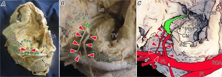 This composite educational material consists of a whole-heart specimen photograph (A), a magnified dissection view (B), and a labeled anatomical illustration (C), demonstrating the vascular supply to the atrioventricular (AV) conduction system from an inferior (diaphragmatic) perspective. The images highlight the AV node artery (red arrowheads) originating from the proximal posterolateral branch (PL) of the right coronary artery (RCA). Panel A shows the macro-anatomical relationship between the RCA, the posterior interventricular artery (PI), and the coronary sinus (CS). Panel B and C detail the inferior pyramidal space (blue dotted area) and the compact node (CN, green star). Key structures visualized include the central fibrous body (CFB), membranous septum (MS), tricuspid valve (TV), and the progression of the conduction axis from the inferior nodal extension (INE) through the penetrating bundle of His (PBH) and the branching bundle of His (BBH). This visual resource is designed for advanced medical education in cardiac anatomy and electrophysiology, specifically illustrating the dominant right coronary artery's contribution to the heart's electrical system.