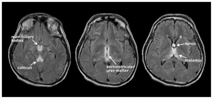 This diagnostic image consists of three axial MRI slices of the brain using Fluid Attenuated Inversion Recovery (FLAIR) sequences, illustrating the classic neuroimaging findings of acute Wernicke encephalopathy. The images demonstrate bilateral, symmetrical hyperintense (bright) signals in specific anatomical regions characteristic of thiamine deficiency. Key structures labeled include the mammillary bodies in the posterior hypothalamus and the colliculi in the midbrain. Higher slices show prominent hyperintensities within the periventricular gray matter surrounding the third ventricle, as well as involvement of the fornix and the medial aspects of the thalamus. These findings represent edema or glial changes associated with the acute clinical manifestation of the disease. The primary educational focus is to teach the radiological signature of Wernicke encephalopathy in the context of chronic alcoholism and nutritional deficiency, emphasizing the typical distribution of lesions in midline brain structures.